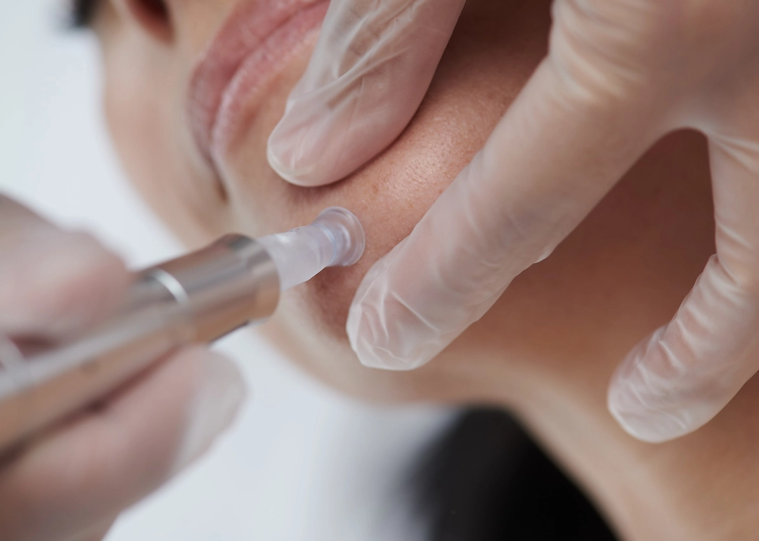 Sunfit_Beauty_Care_Dermalogica_Microneedling_Gezicht_Hals